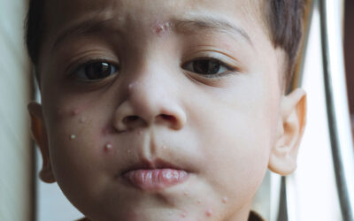 All about Chickenpox and its Prevention