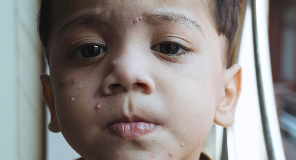 All about Chickenpox and its Prevention